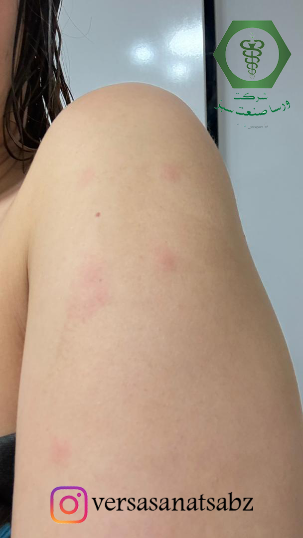 علایم گزش ساس، آثار گزش ساس، اثرات گزش ساس، نشانه های گزش ساس